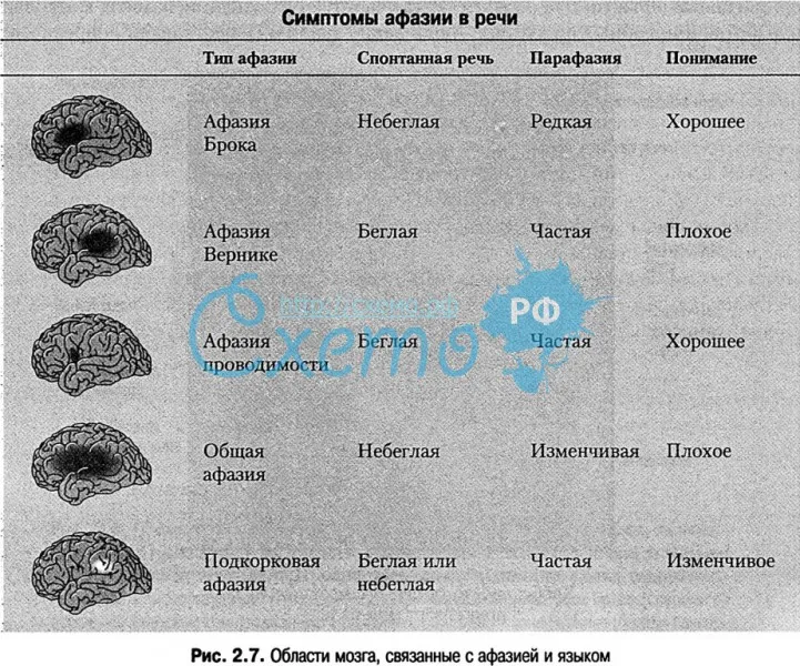 Области мозга, связанные с афазией и языком