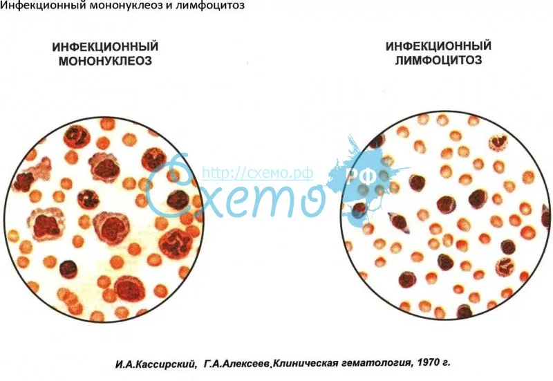 Инфекционный мононуклеоз и лимфоцитоз