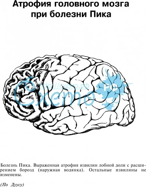 Атрофия головного мозга при болезни Пика