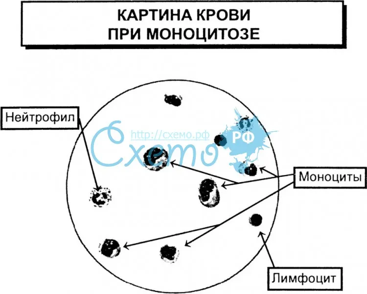 Картина крови при моноцитозе