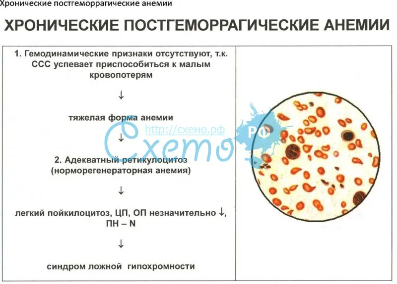 Хронические постгеморрагические анемии