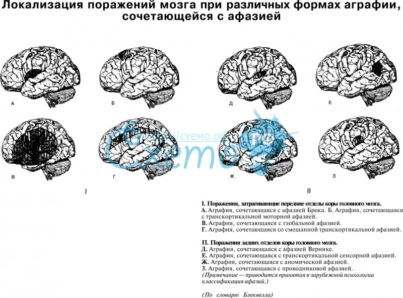 Локализация поражений мозга при различных формах аграфии, сочетающейся с афазией