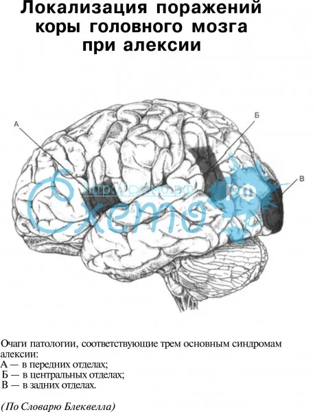 Локализация поражений коры головного мозга при алексии