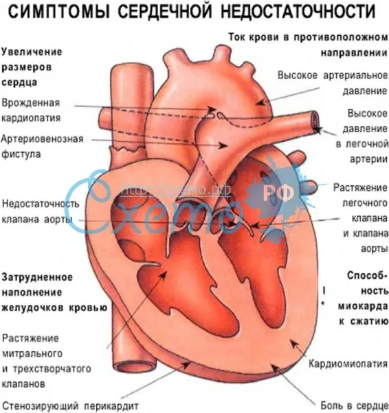 Симптомы сердечной недостаточности