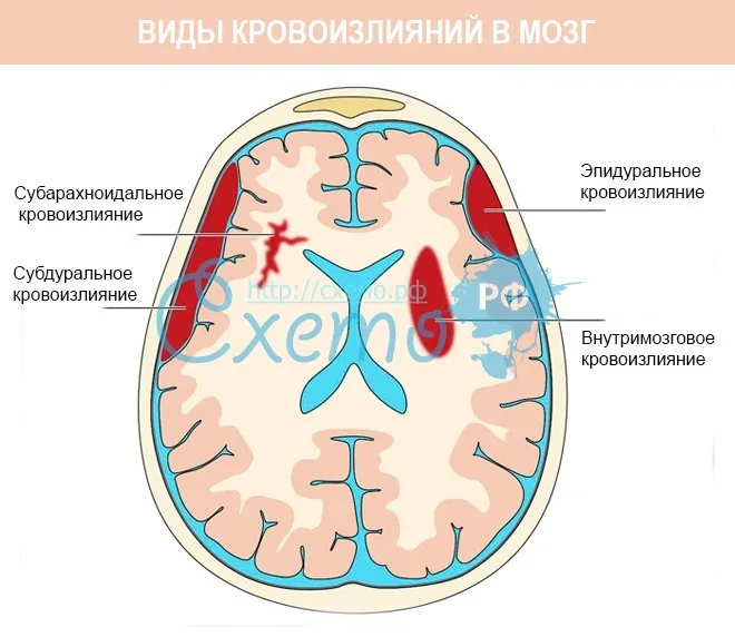 Кровоизлияние в мозг (субарахноидальное, внутримозговое, эпидуральное, субдуральное)