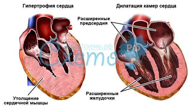 Гипертрофия и дилатация камер сердца