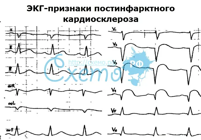 ЭКГ-признаки постинфарктного кардиосклероза