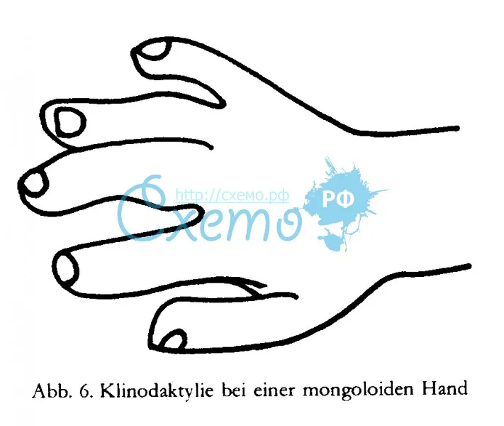 Клинодактилия монголоидной руки