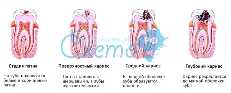 Кариес зубной, стадии